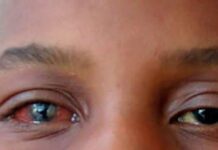 Conjonctivite à Dakar : le Dr Boubacar Sarr alerte sur les risques de contagion